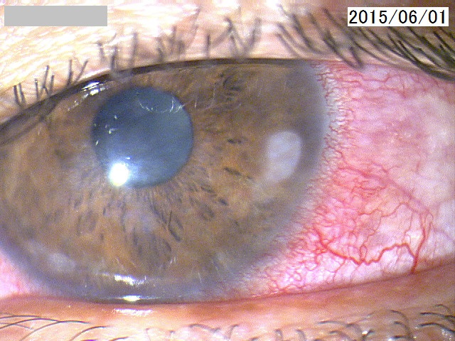 角膜が傷つきばい菌が感染した細菌性角膜炎
